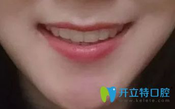 結(jié)束正畸，戴保持器圖片