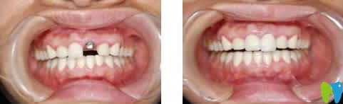 昆明尚愛韓美口腔李兵院長(zhǎng)種植牙案例效果圖