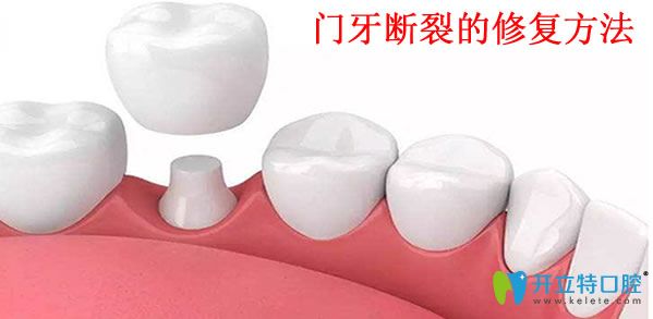 美麗雅口腔門(mén)牙斷裂的修復(fù)方法 美麗雅口腔門(mén)牙斷裂的修復(fù)方法