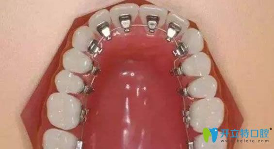 牙套的種類(lèi)之舌側(cè)隱形矯正器