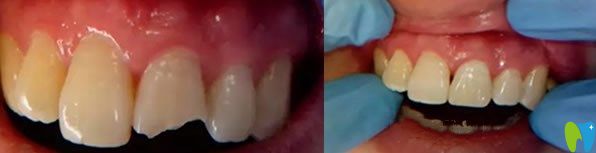 門(mén)牙缺失美容冠修復(fù)代表案例 門(mén)牙缺失美容冠修復(fù)代表案例