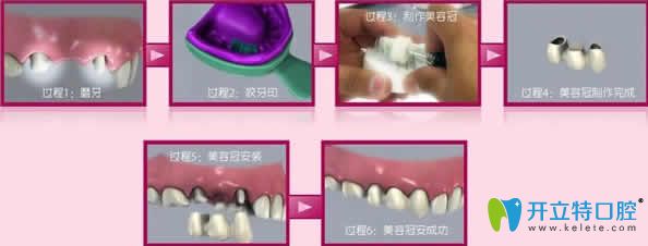 牙齒美容冠治療步驟圖