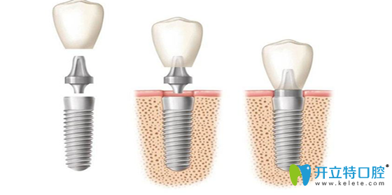 即刻種植牙好嗎