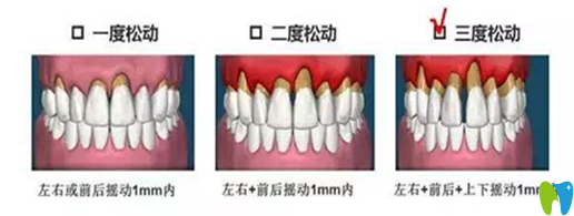 牙齒松動治療辦法和松動程度有關