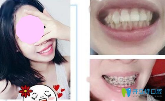 廣州歐頓口腔美國(guó)3M金屬托槽牙齒矯正案例