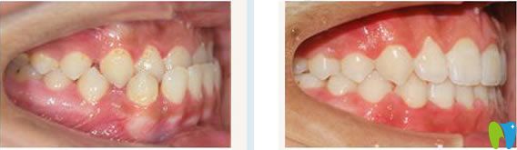 南寧柏樂口腔陳世穩(wěn)門牙反頜矯正案例及前后對比效果