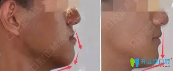 成都圣貝賈永慶醫(yī)生深覆合矯正及臉型變化圖