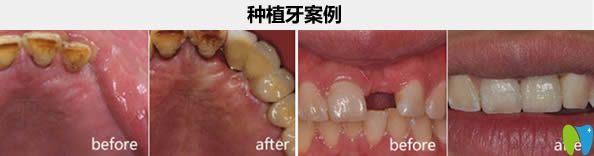 南昌維樂口腔汪文文種植牙實例