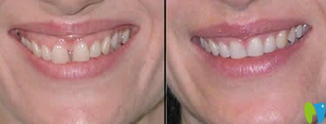 門牙中間有縫矯正前后對(duì)比圖