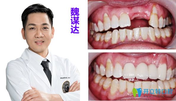 南京牙博士口腔魏謀達(dá)種植牙效果案例