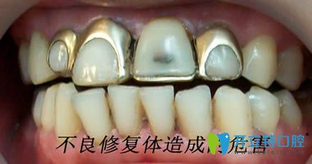 開(kāi)立特口腔不良修復(fù)體造成的危害