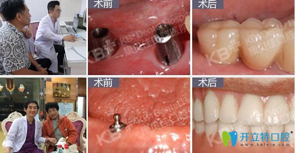 康貝佳口腔全口牙缺失種植修復(fù)效果
