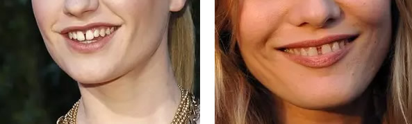 求問：牙縫大怎么辦如何矯正 樹脂補(bǔ)牙縫和全瓷牙選哪個(gè)好