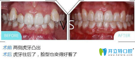 黃飛醫(yī)生給我做虎牙矯正前后對比圖