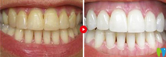 黃飛的皓齒美白案例