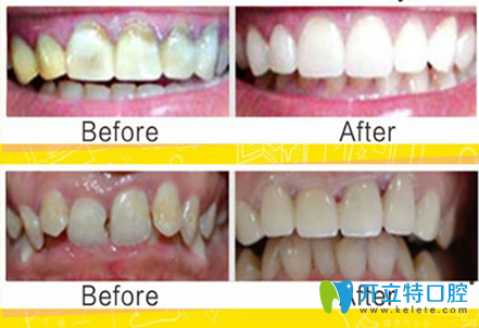 黃圣奇3D瓷?？萄例X修復(fù)真人案例