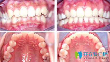 福州美可普口腔牙齒矯正對比圖