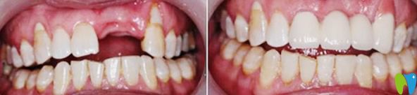 <!--<i data=20240703-sp></i>-->口腔門牙缺失種植修復(fù)案例