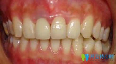 鎳鉻烤瓷牙修復(fù)圖