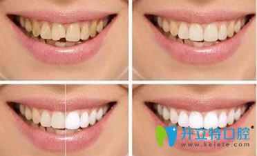 硬質(zhì)貼面是比較理想的美白修復(fù)方式