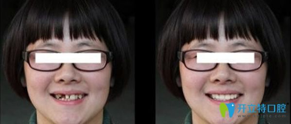 <!--<i data=20240703-sp></i>-->億大口腔即刻種植牙效果怎么樣
