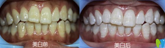 天津美萊口腔靠譜嗎？來看顧客冷光美白治療前后效果對比