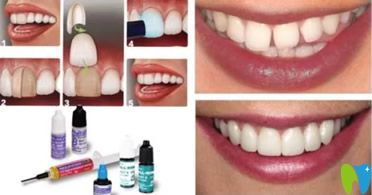 樹脂貼面相對來說價格稍低