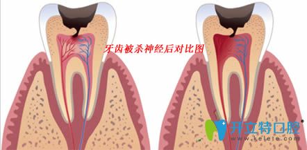 呼和浩特紅十字口腔解說牙齒摘除神經后疼痛的原因與對策