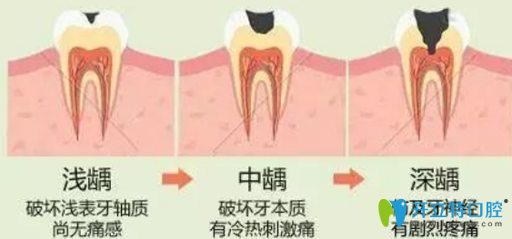 補牙的價格和牙齒齲壞的程度有關(guān)