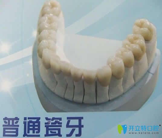 普通烤瓷牙多少錢一顆及能用多久 點擊這里有你想知道的