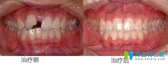 屬于天津美萊口腔的牙齒錯位、牙間縫矯正案例