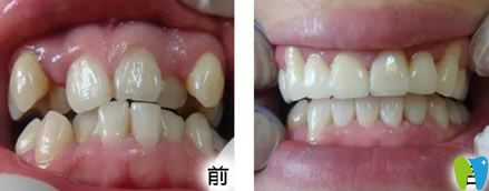 壹加壹口腔矯正牙齒前后療效對(duì)比 壹加壹口腔矯正牙齒前后療效對(duì)比