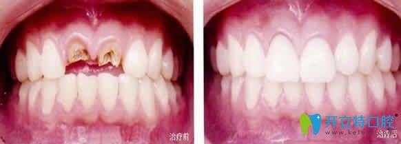 重慶嘉悅口腔即刻種植牙效果圖 重慶嘉悅口腔即刻種植牙效果圖