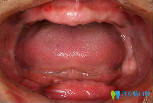 我?guī)Я?0年的活動假牙，沒做種植牙卻讓活動假牙害我一生啊
