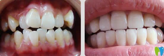 重慶嘉悅口腔周繼祥正畸案例效果圖