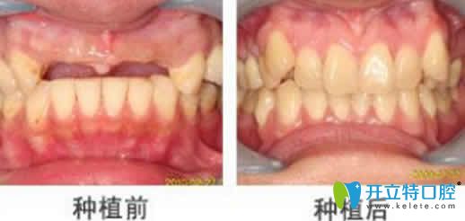 蘭州惠安齒科種植牙圖 蘭州惠安齒科種植牙圖