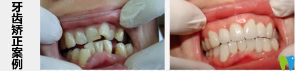 長(zhǎng)沙愛思特口腔成人牙齒矯正案例