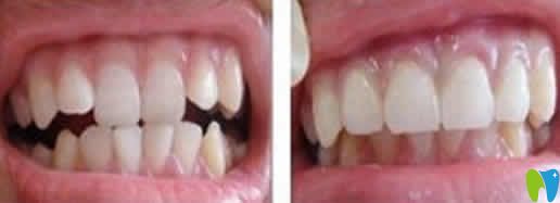 蘭州惠安齒科牙齒矯正前后對(duì)比圖 蘭州惠安齒科牙齒矯正前后對(duì)比圖