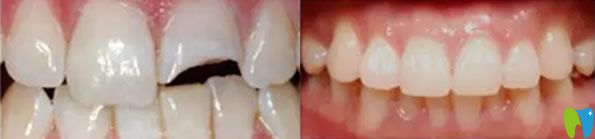 門牙掉了一塊補(bǔ)后效果對(duì)比圖