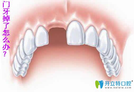 想知道20多歲門牙掉了怎么辦？能做種植牙嗎