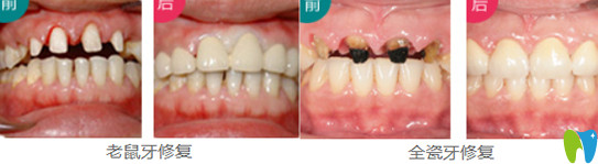 珠海愛思特韓繼新院長牙齒修復(fù)案例 珠海愛思特韓繼新院長牙齒修復(fù)案例