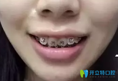 在東莞好佰年口腔做牙齒正畸戴牙套第1天