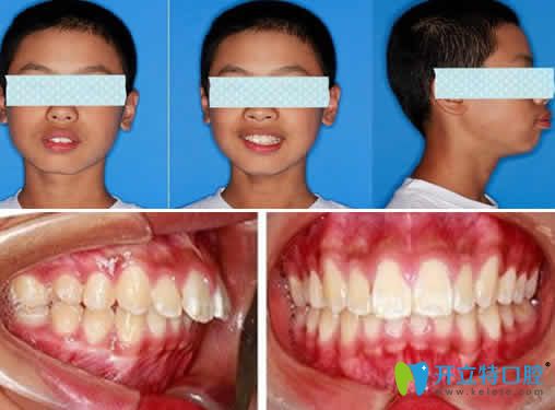 無錫金貝齊齒科13歲孩子牙齒矯正前的照片