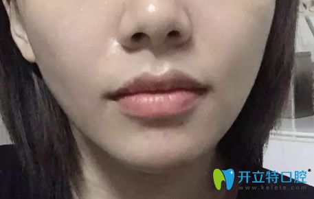 東莞好佰年口腔牙齒矯正即將完成