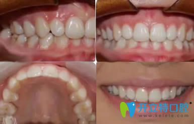 寧波壹加壹口腔正畸后的牙齒圖