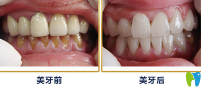 牙衛(wèi)士口腔5D納米全瓷貼面術(shù)前術(shù)后對比案例