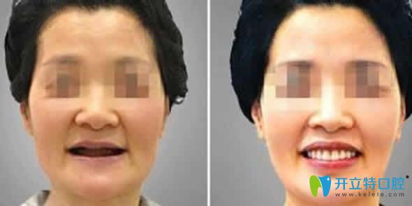 <!--<i data=20240703-sp></i>-->口腔即刻種植牙前后效果圖