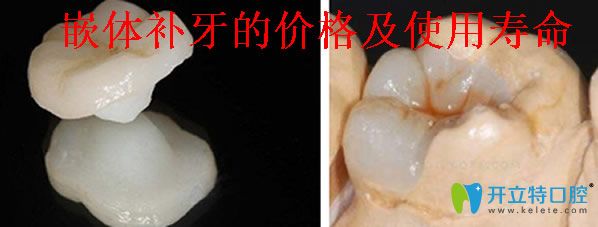 嵌體補(bǔ)牙的價(jià)格及使用壽命