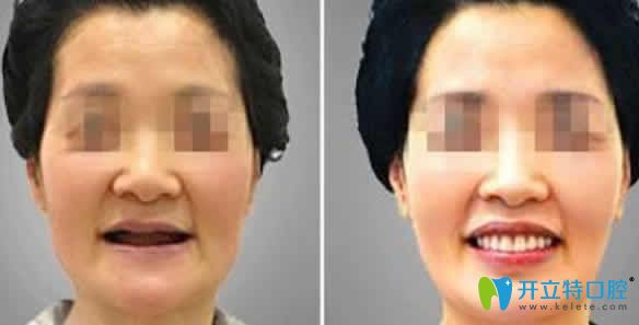 合肥世佳口腔種植牙案例效果圖