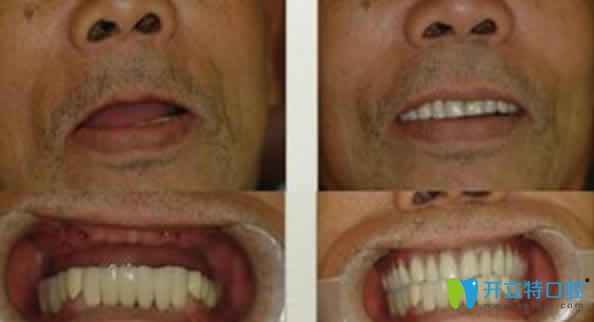 ?？趪趴谇环N植牙案例效果圖